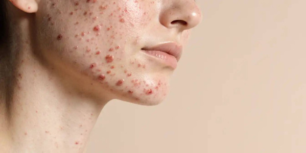 Akné u dospělých: proč vzniká a jak ho řešit
